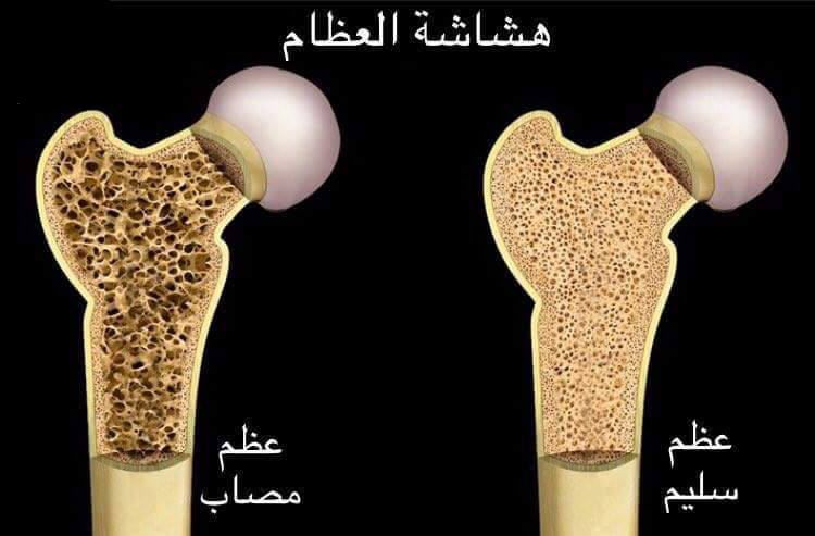 اعراض هشاشة العظام عند النساء